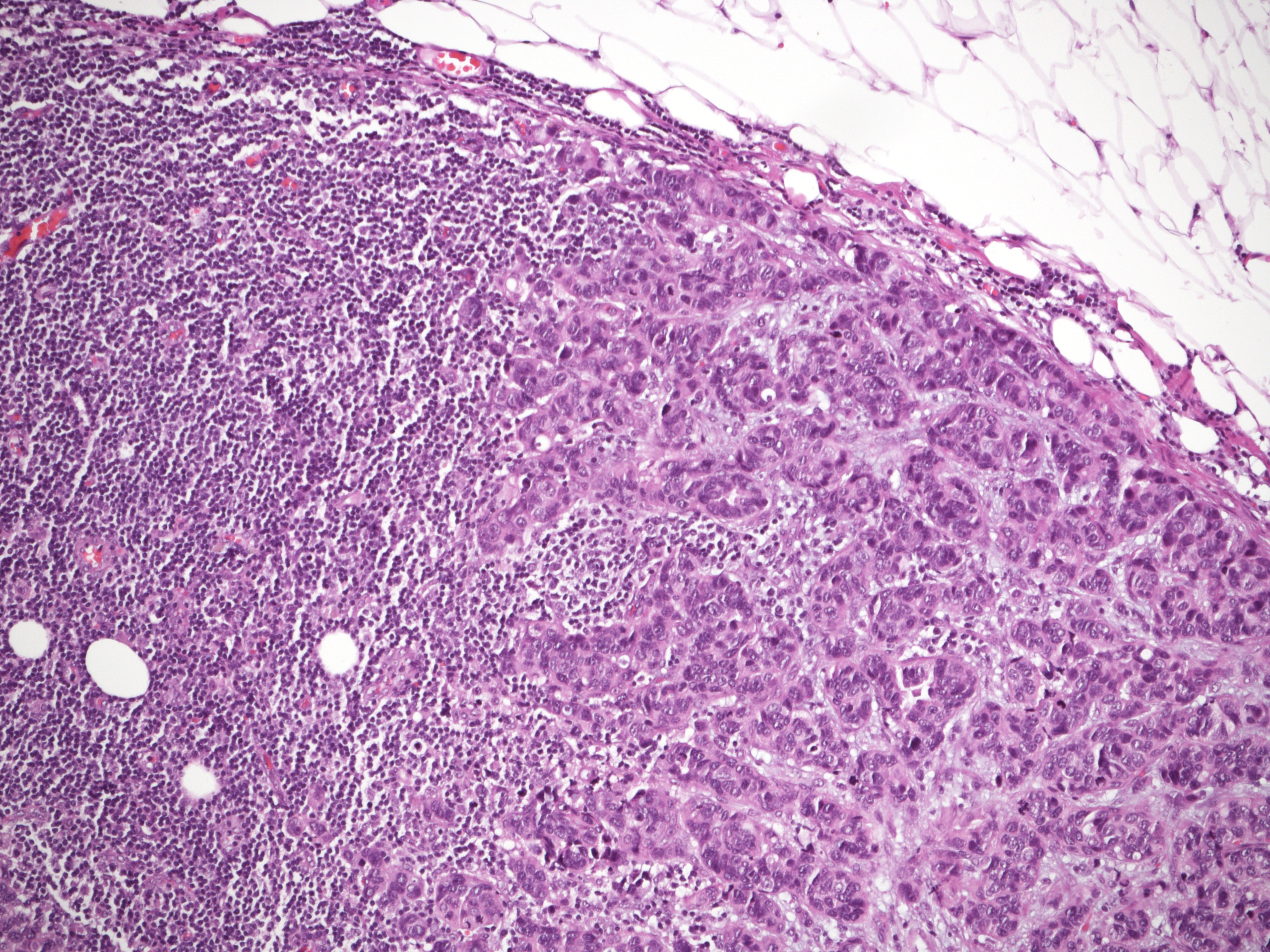 Colorectal cancer lymph nodes. Save citation to file